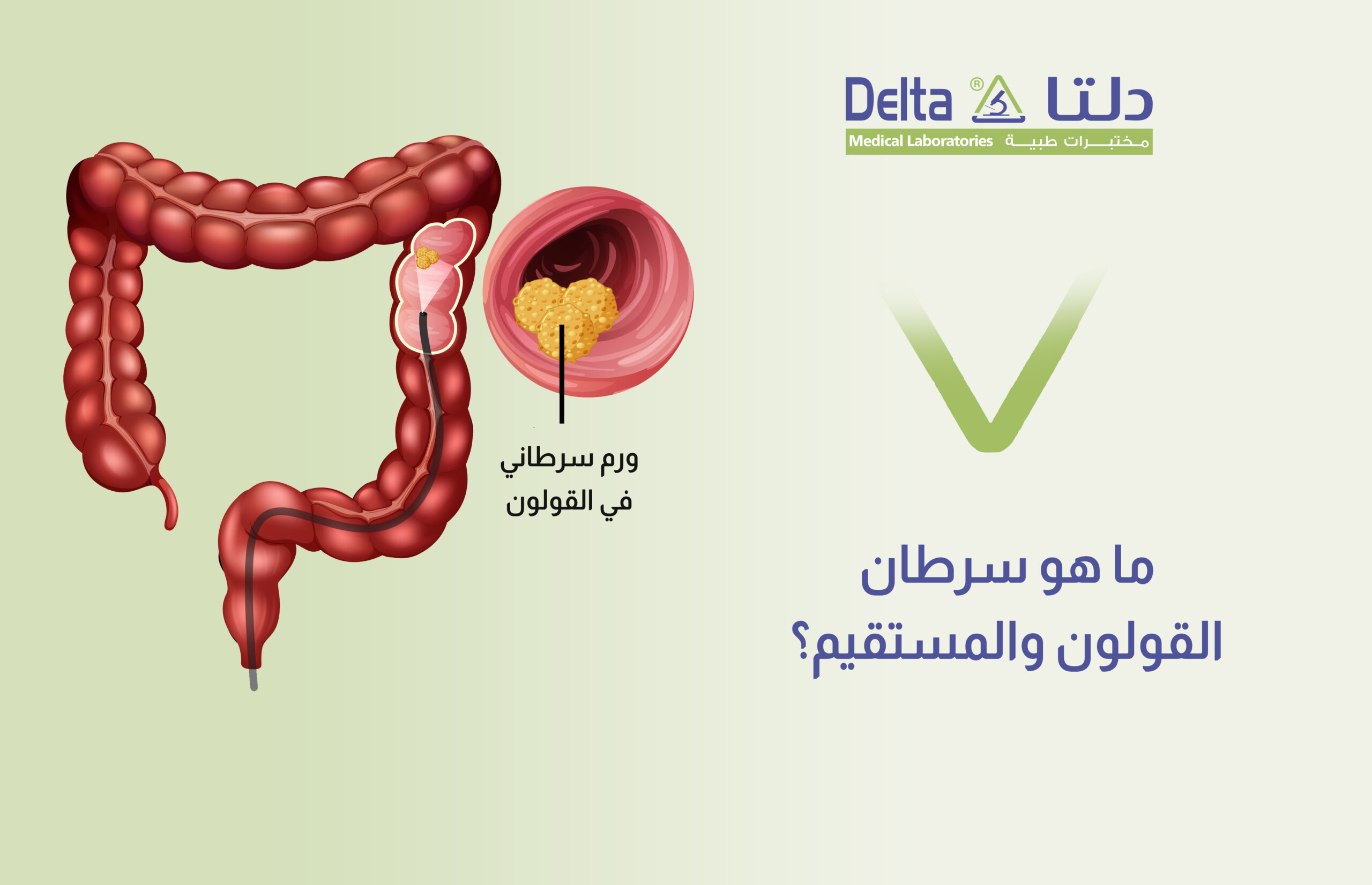 ما هو سرطان القولون والمستقيم