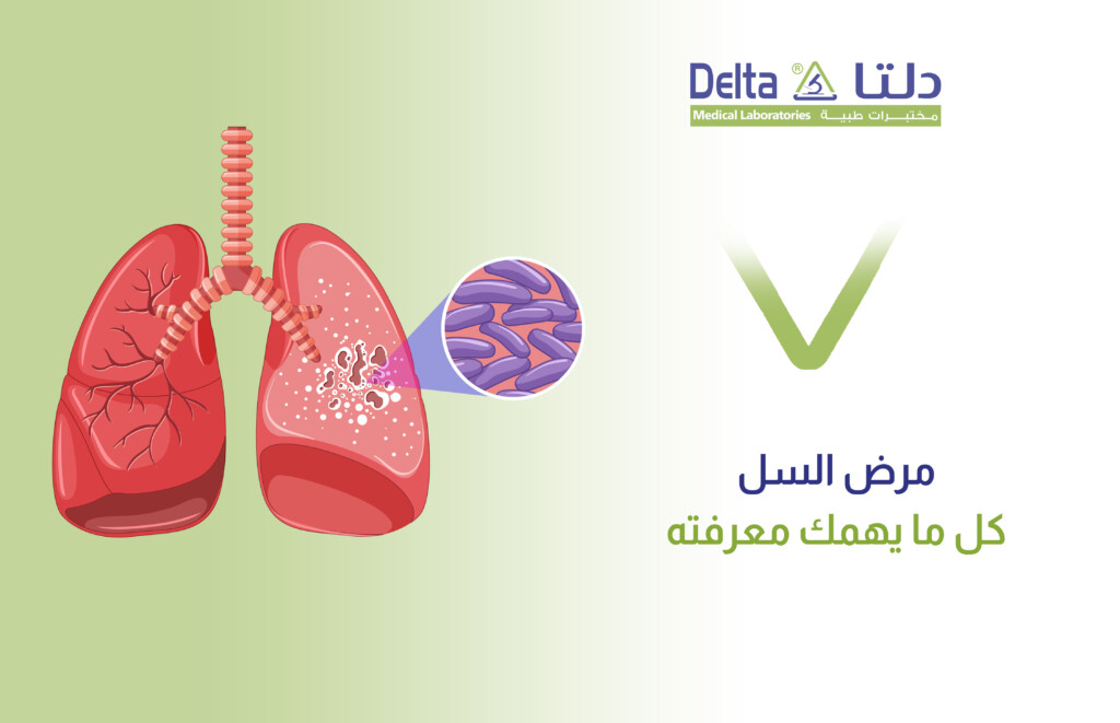 ما هو مرض السل ، وهل مرض السل مميت، وما هي أعراض السل وأسبابه وطرق تشخيصه وعلاجه