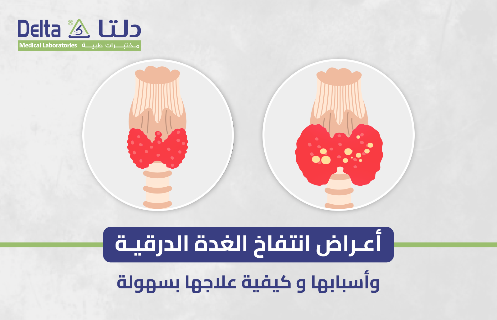 أعراض انتفاخ الغدة الدرقية وأسبابها و كيفية علاجها بسهولة